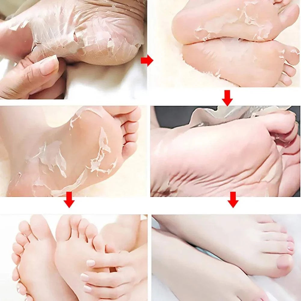 Nomilora Exfoliating Foot Mask before and after usage, showing effective dead skin removal and foot care results.