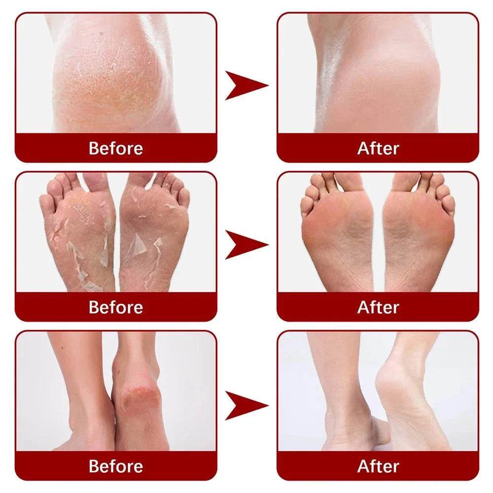 Before and after results of using Nomilora Exfoliating Foot Mask showing smooth and soft feet.